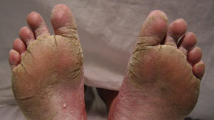 foot infections