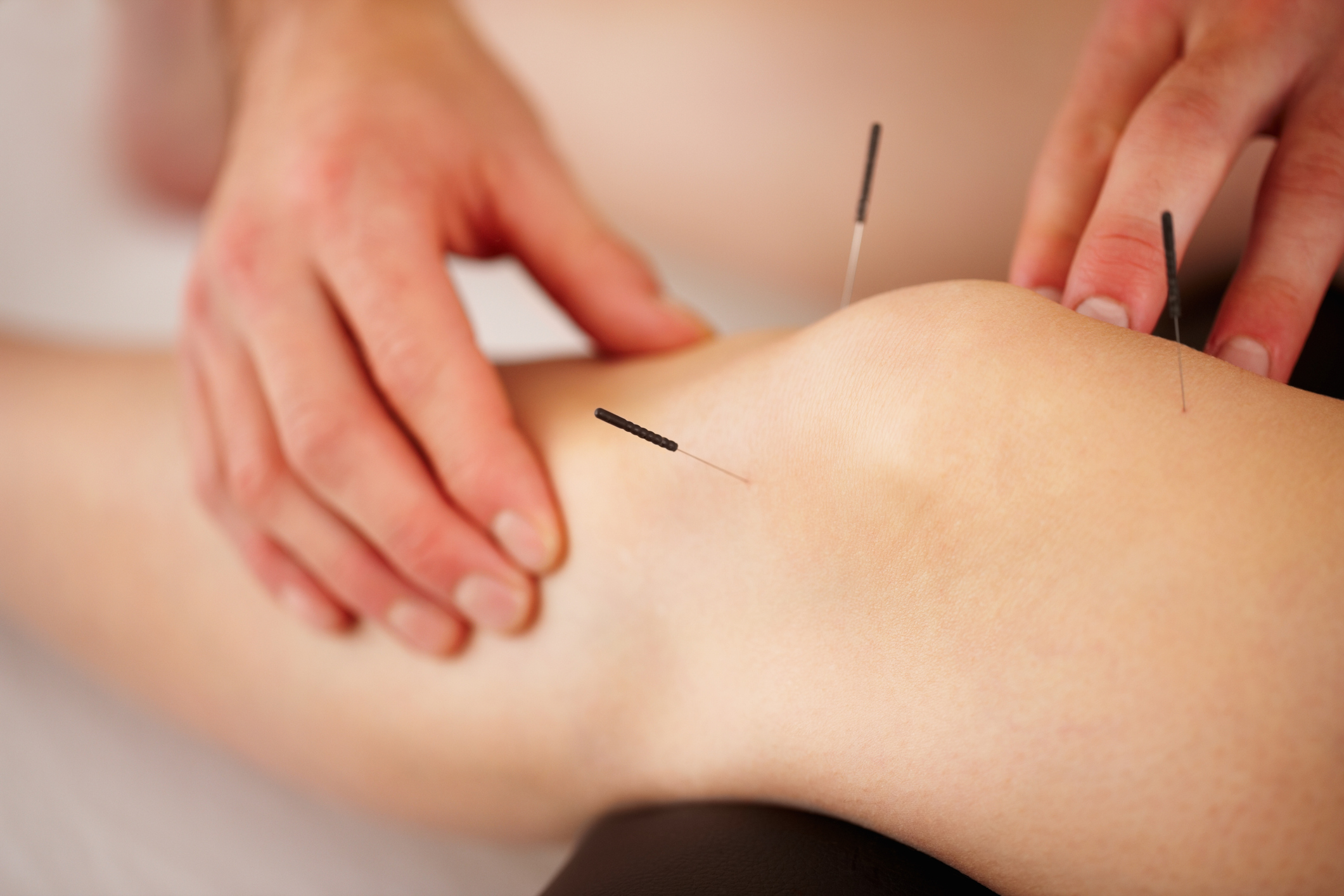 The Most Reliable And Safe Acupuncture Clinic